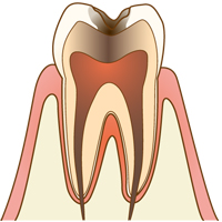 歯髄（神経）に達した虫歯